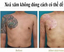 Xoá Xăm Cần Kiêng Những Gì